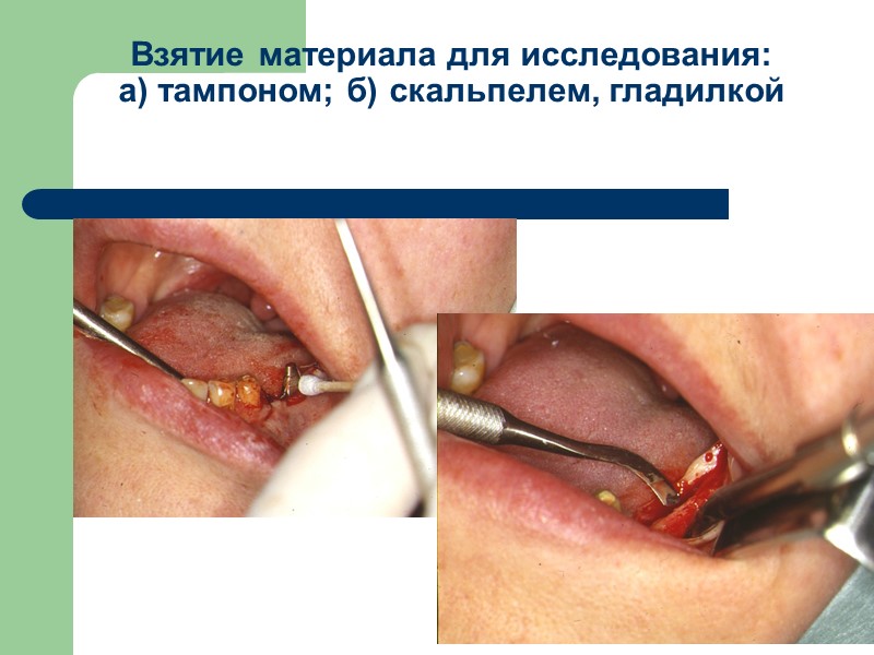 Взятие материала для исследования: а) тампоном; б) скальпелем, гладилкой